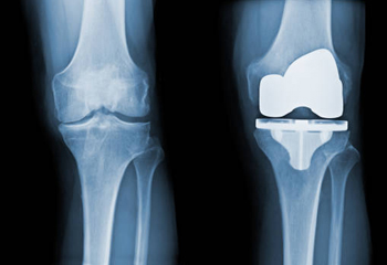 Orthopedic Treatment in Jalandhar