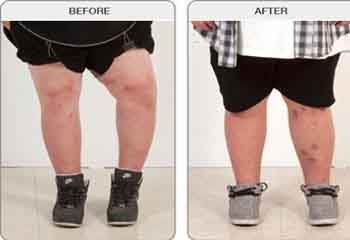 limb lengthening treatement in jalandhar
