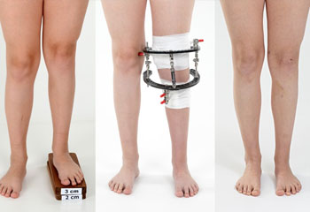 limb lengthening Surgeon in jalandhar
