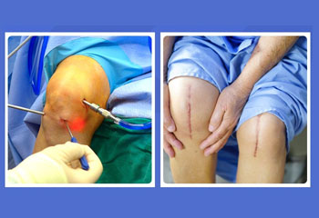 arthroscopy Surgeon in jalandhar