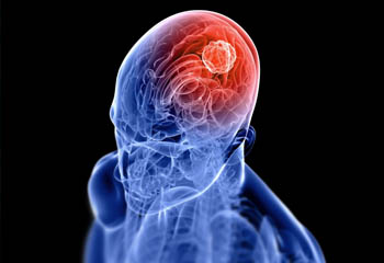 Brain Tumours doctor in jalandhar