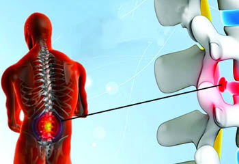 Slipped disc operation with microscope in jalandhar